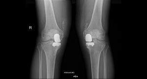 Protesi monocompartimentale bilaterale simultanea di ginocchio