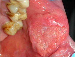 Carcinoma orale