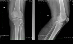 Radiografia in due proiezioni di un ginocchio normale