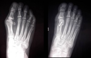 (FOTO 4a 4b Radiografie prima e dopo l’intervento di osteotomia  del primo metatarsale)