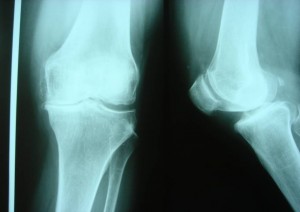 Radiografia di un ginocchio con un evidente consumo dello spazio tra femore e tibia, sulla parte mediale (ginocchio varo)