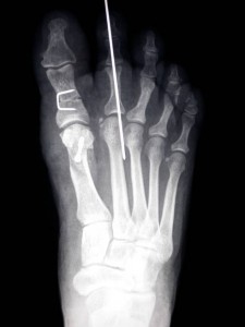 (FOTO 5 Radiografie dopo l’intervento di osteotomie eseguite in due sedi diverse  - metatarso e falange, associata alla correzione del 2 dito a martello )