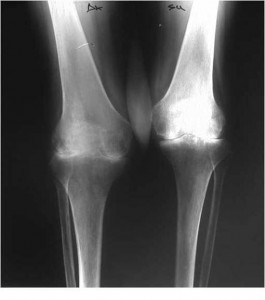Radiografia di due ginocchia con esteso consumo articolare più evidente al ginocchio destro (sinistra nell’immagine) in paziente affetta da artrite reumatoide