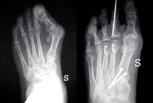 (FOTO 6a 6b Radiografie di osteotomie multiple dell’avampiede per correggere grave deformità associata a metatarsalgia e dita a martello)