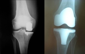 Immagini radiografiche: a sinistra una protesi monocompartimentale (è stata rivestita solo la parte interna dell’articolazione tra femore e tibia), a destra una protesi bicompartimentale (sono state rivestite entrambe le superfici tra femore e tibia)