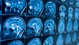 Radiografia-del-cervello
