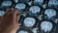 diagnosi_tumore_cervello