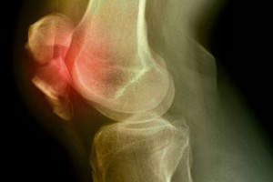 Kneecap fracture, X-ray